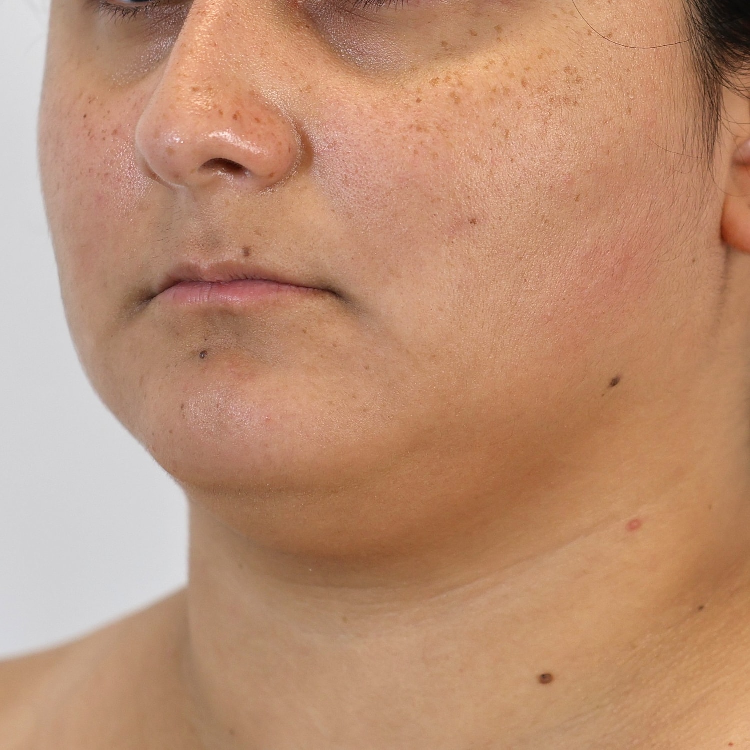 Neck Liposuction Before & After