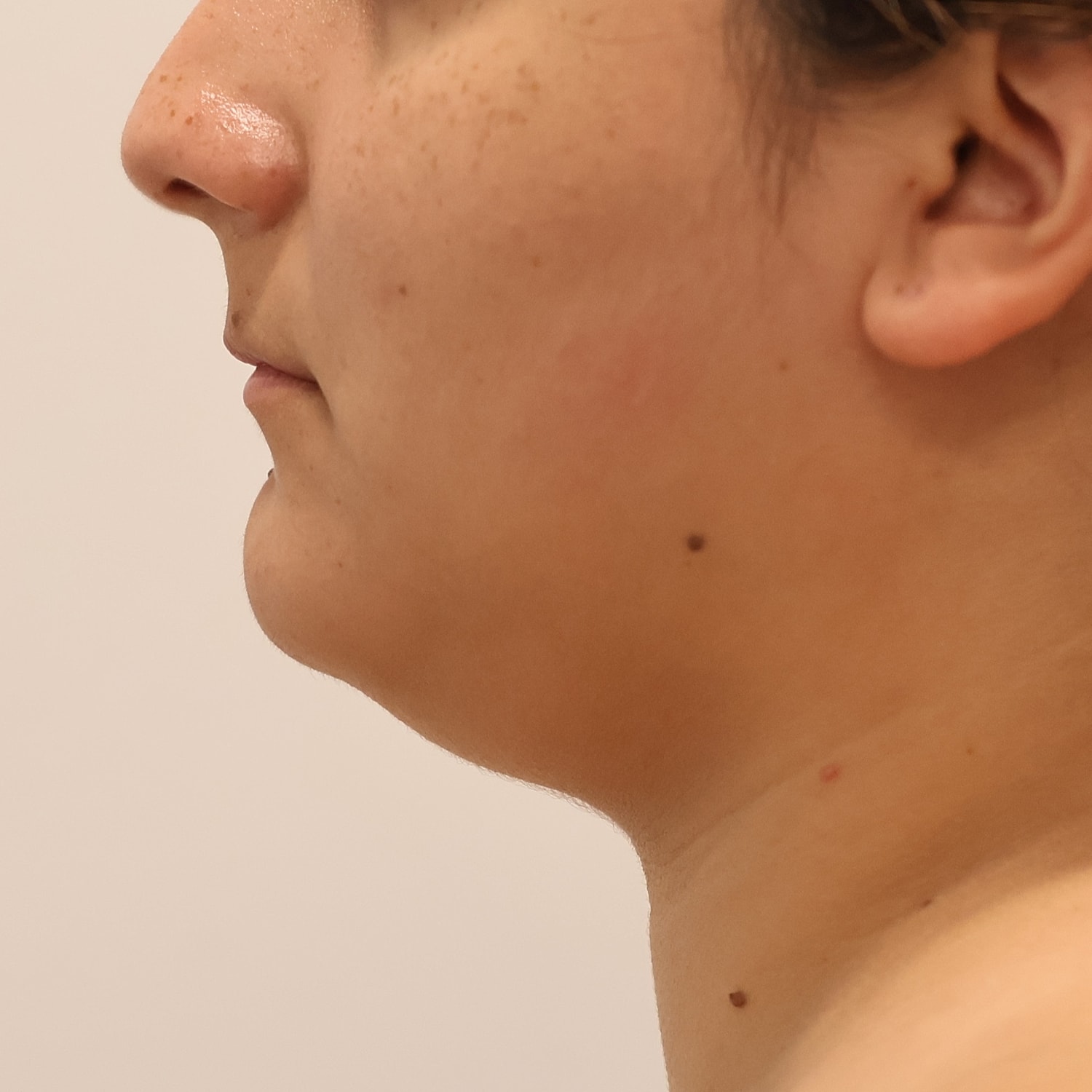 Neck Liposuction Before & After