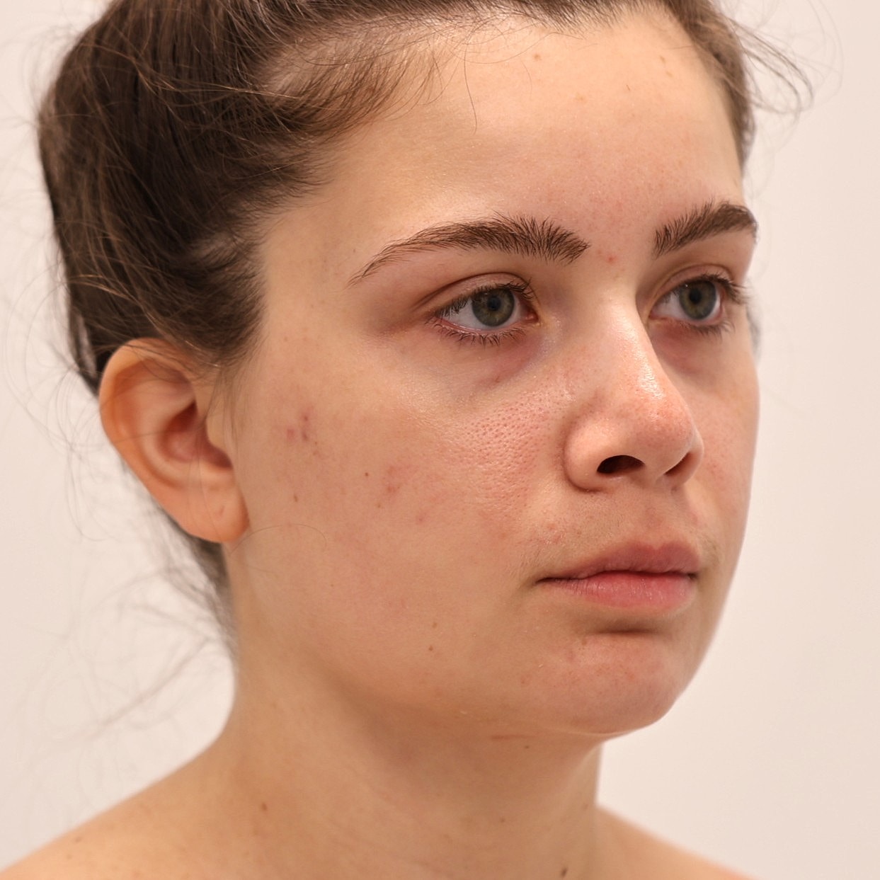 Neck Liposuction Before & After