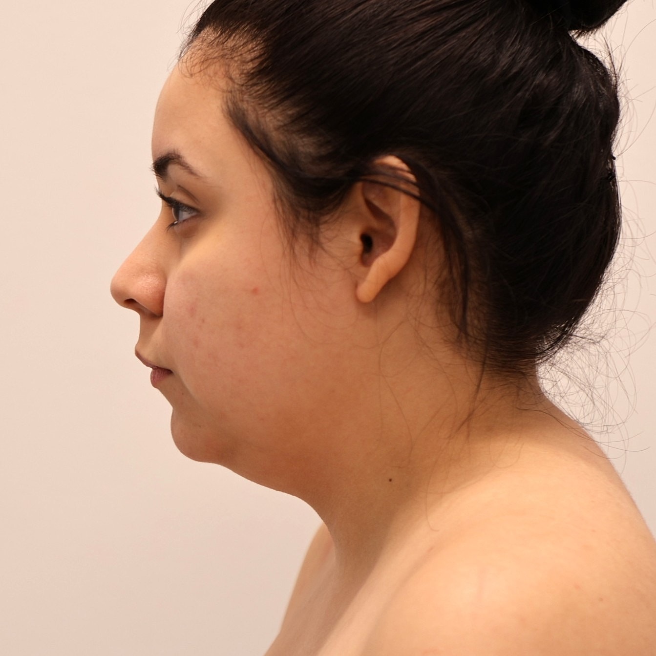 Neck Liposuction Before & After