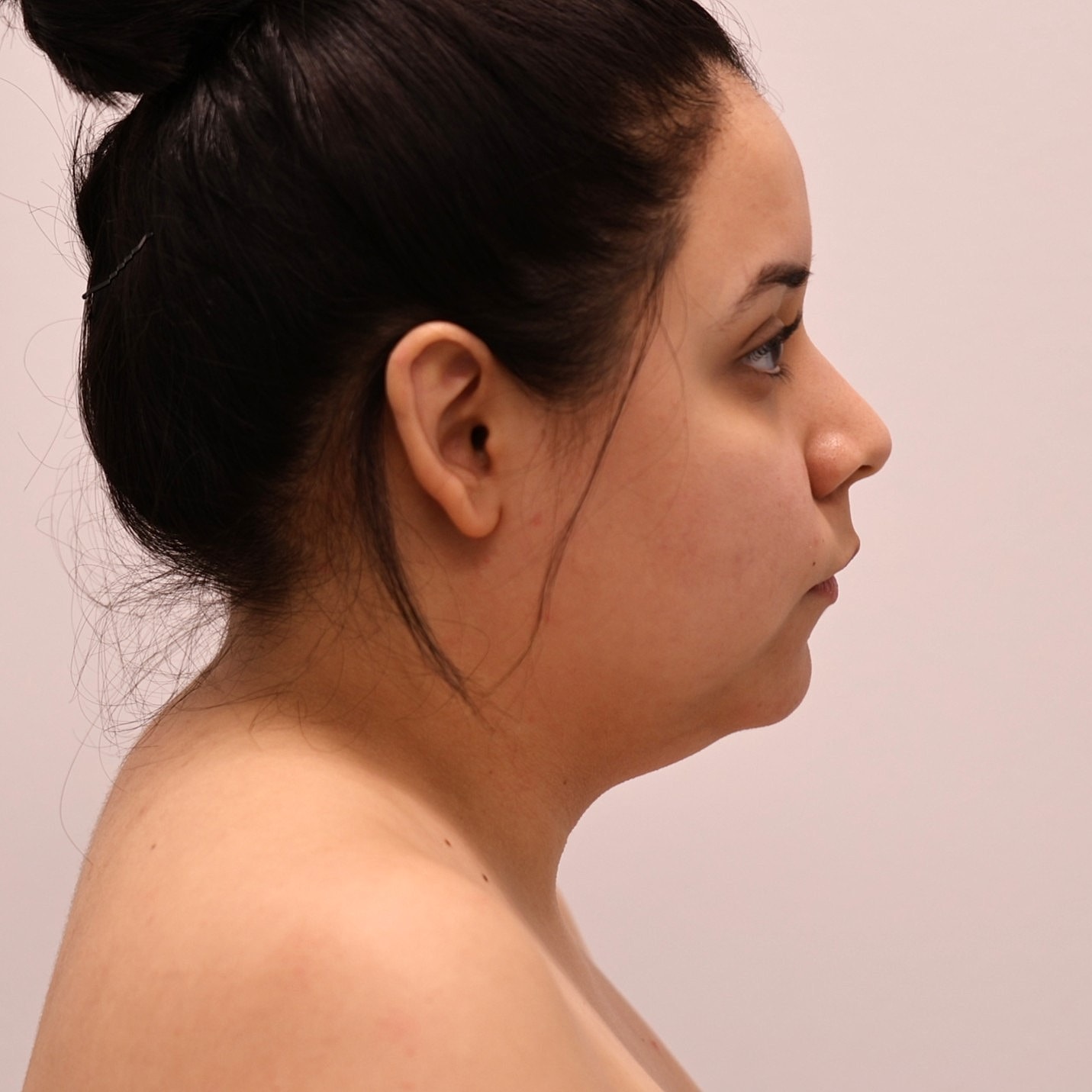 Neck Liposuction Before & After