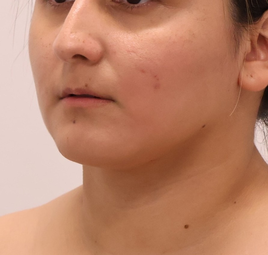 Neck Liposuction Before & After
