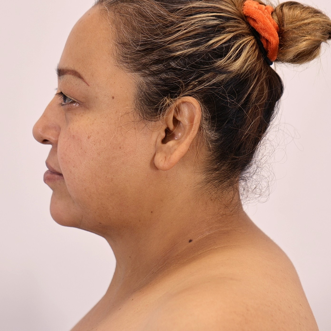 Neck Liposuction Before & After