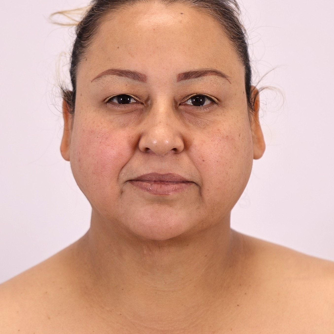 Neck Liposuction Before & After