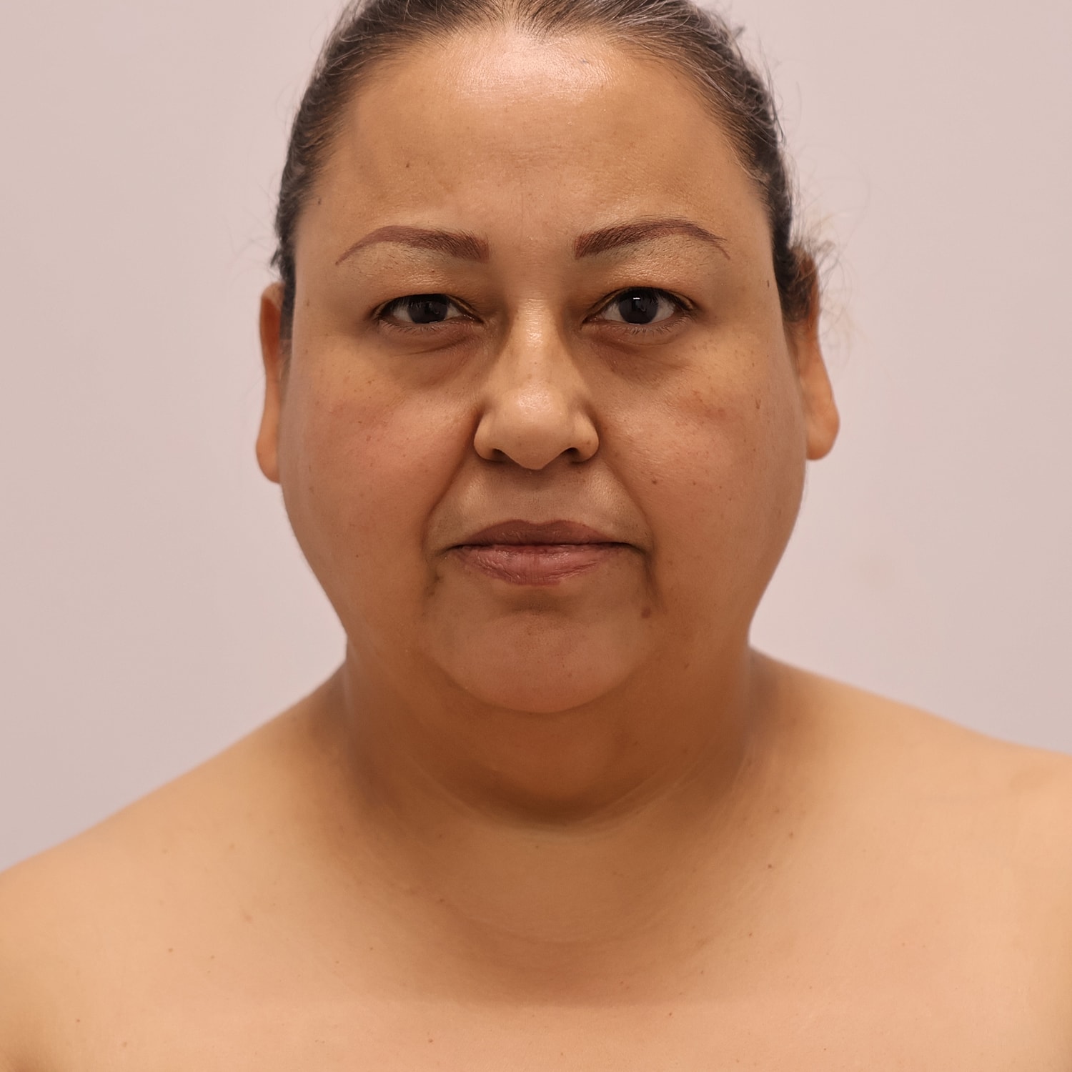 Neck Liposuction Before & After