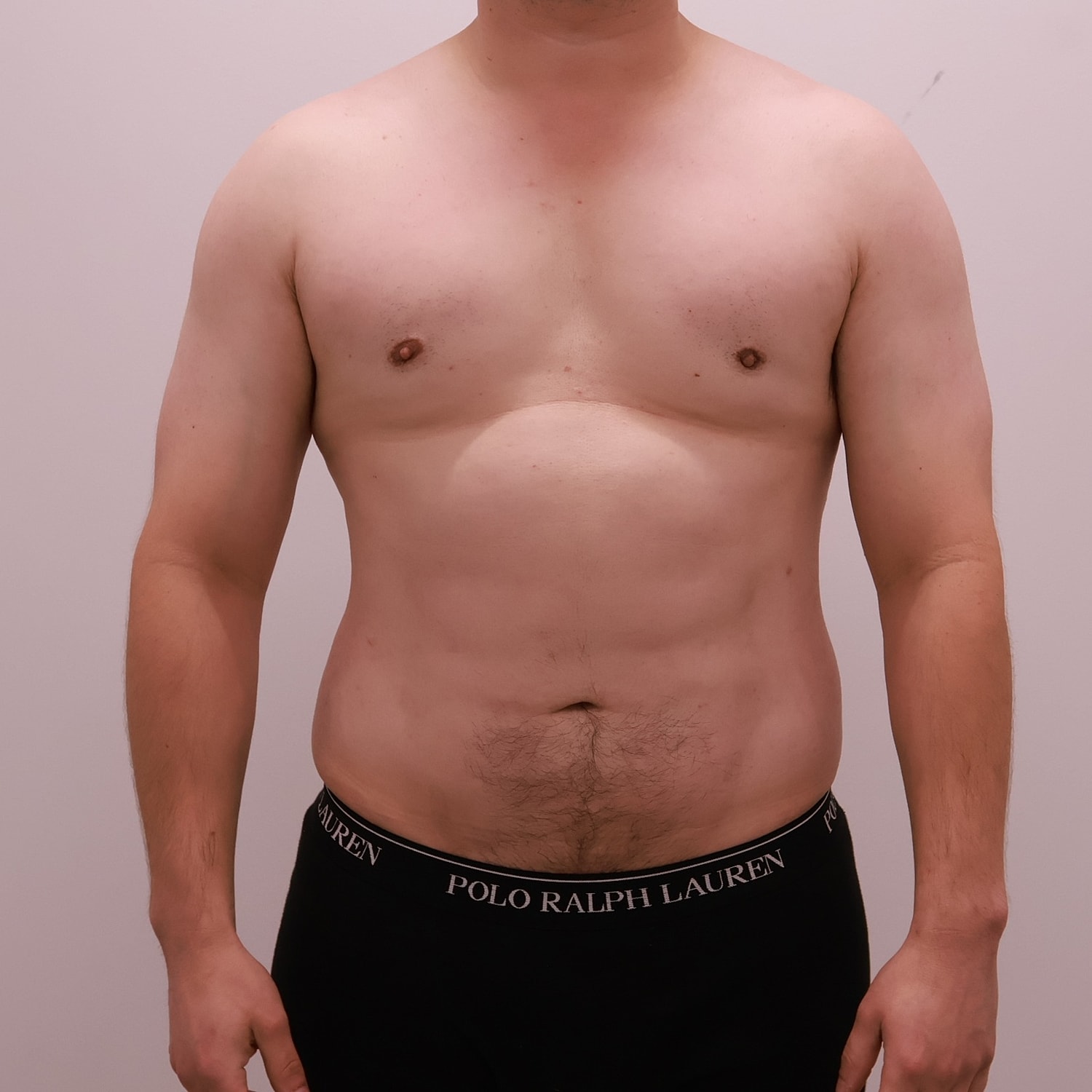 Male Breast Gynecomastia Before & After