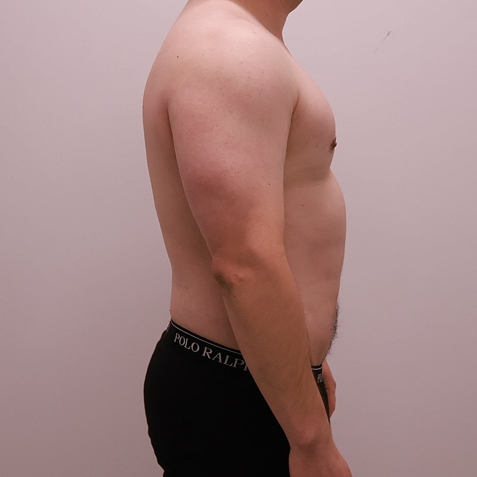 Male Breast Gynecomastia Before & After