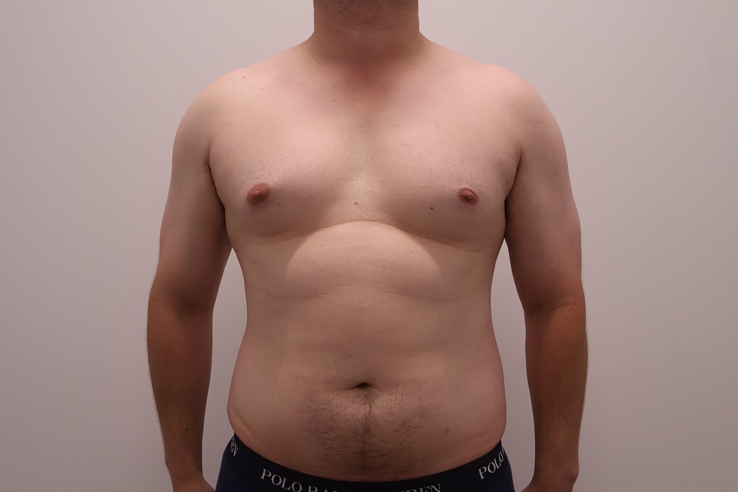 Male Breast Gynecomastia Before & After