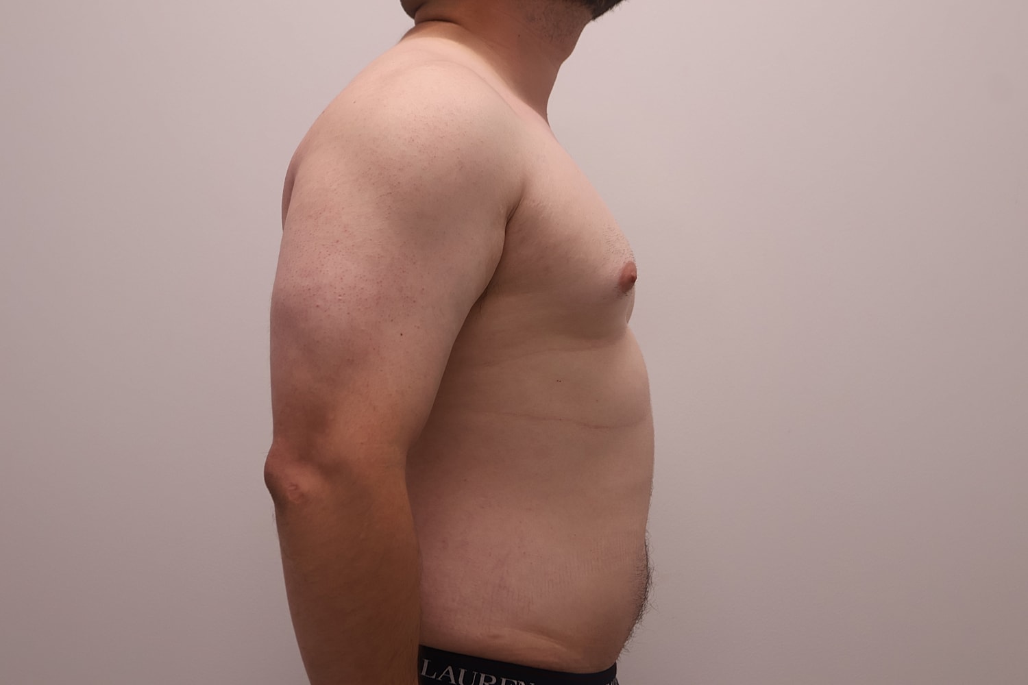 Male Breast Gynecomastia Before & After