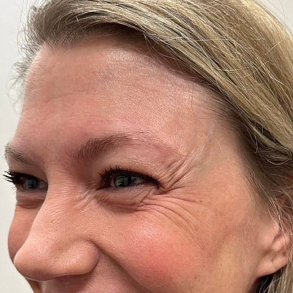 Botox Before & After