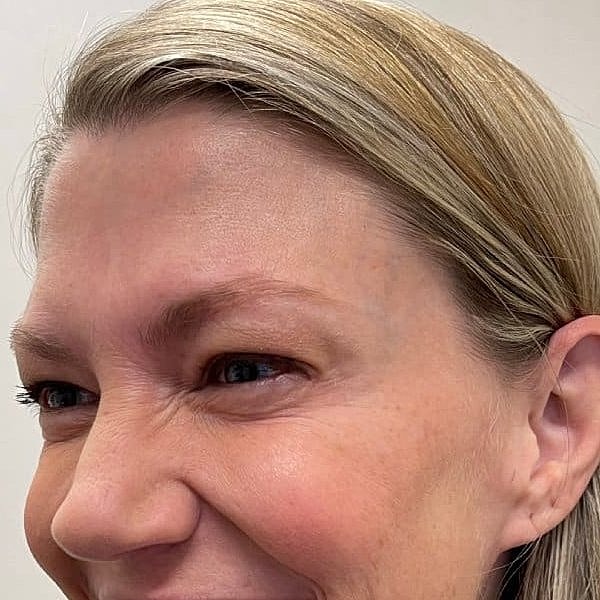 Botox Before & After