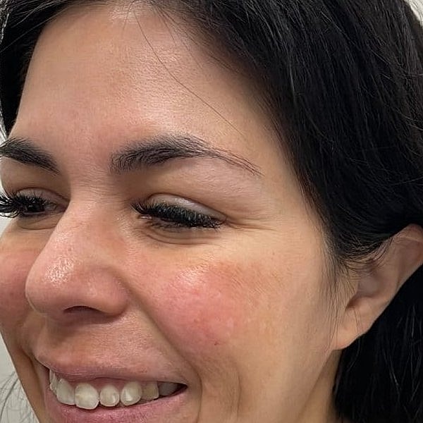 Botox Before & After