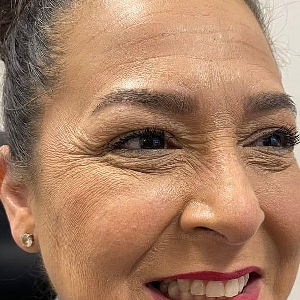 Botox Before & After