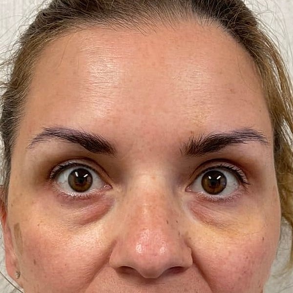 Botox Before & After