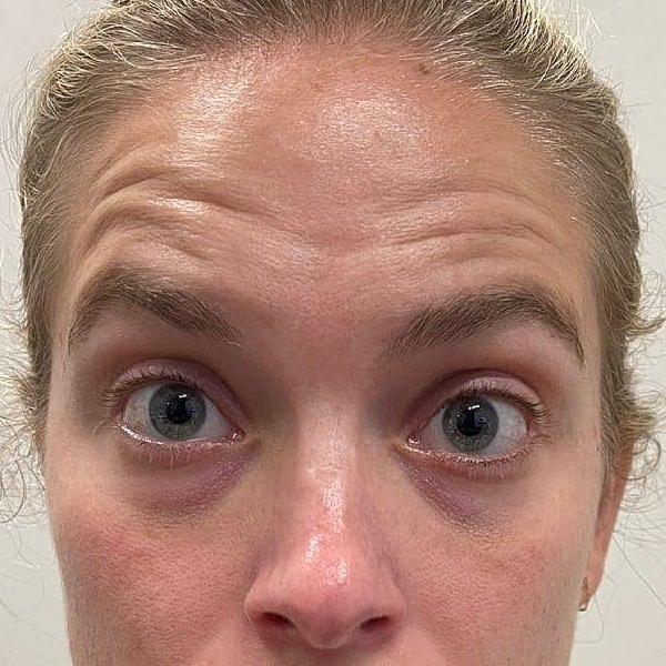 Botox Before & After
