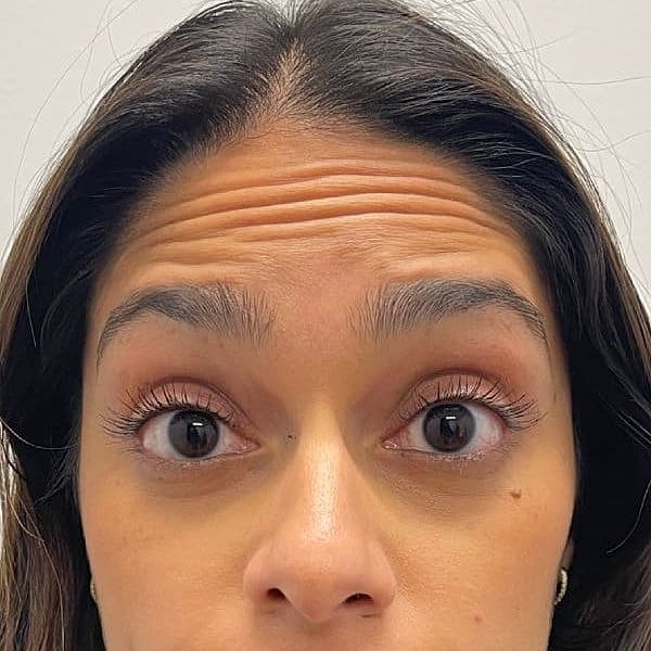 Botox Before & After