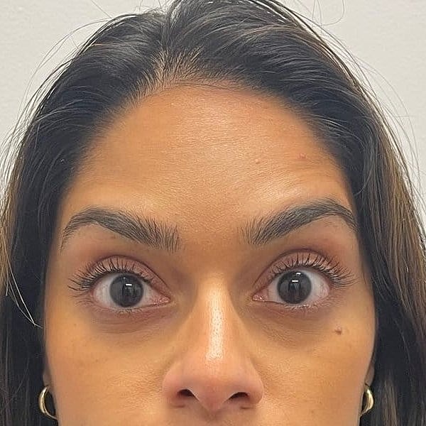 Botox Before & After