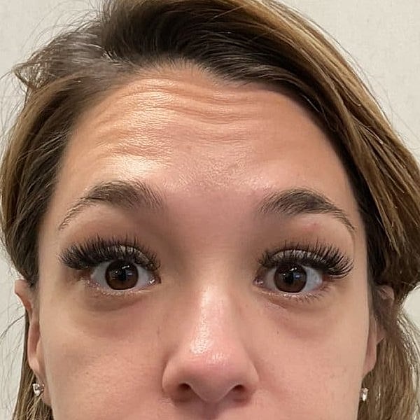 Botox Before & After