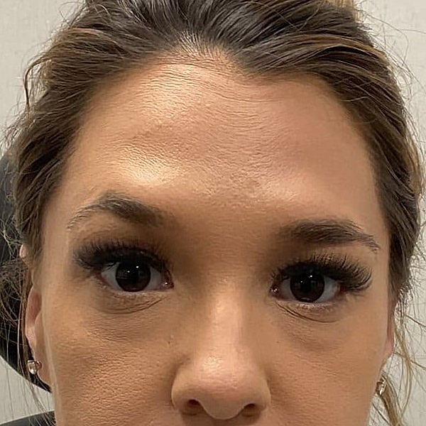 Botox Before & After