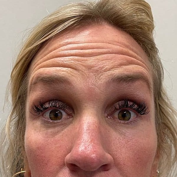 Botox Before & After