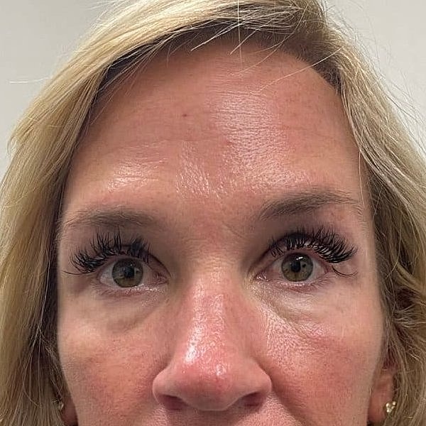 Botox Before & After