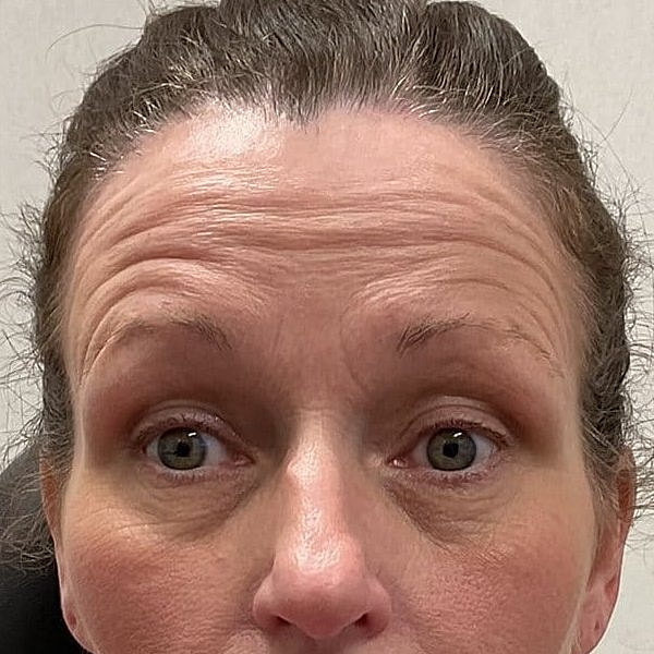 Botox Before & After