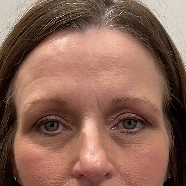 Botox Before & After