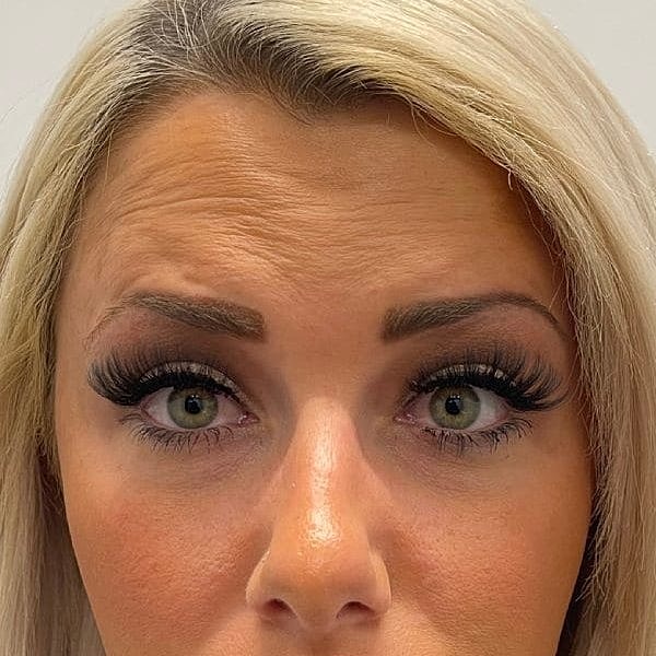 Botox Before & After