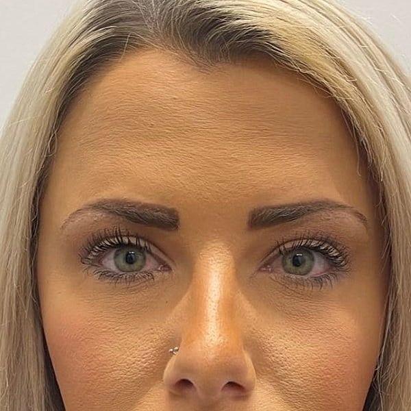 Botox Before & After