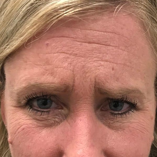 Botox Before & After