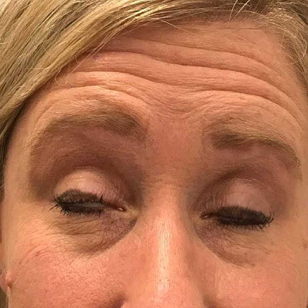 Botox Before & After