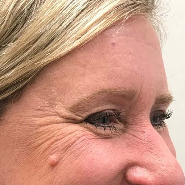 Botox Before & After