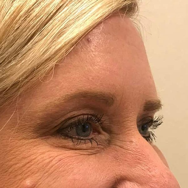 Botox Before & After