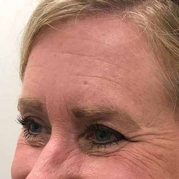 Botox Before & After