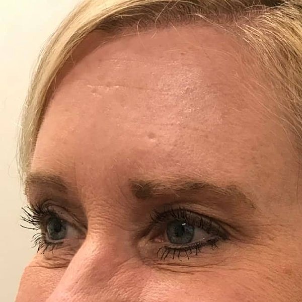 Botox Before & After