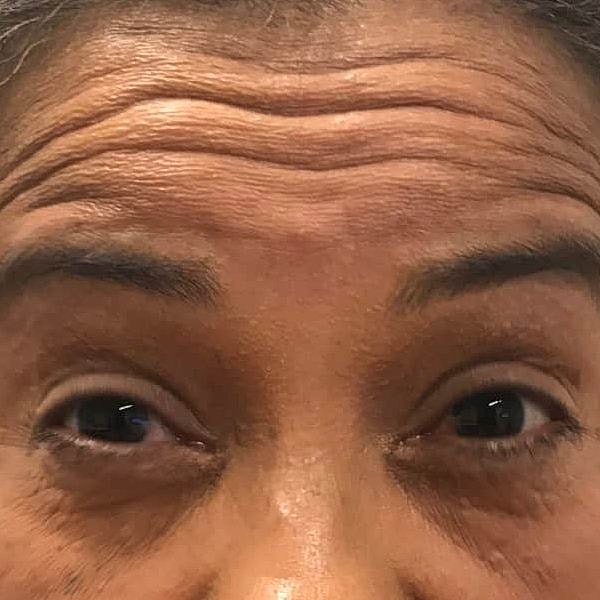 Botox Before & After