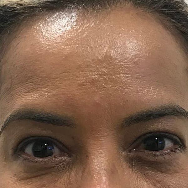 Botox Before & After