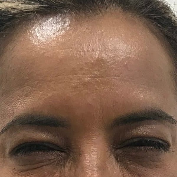 Botox Before & After