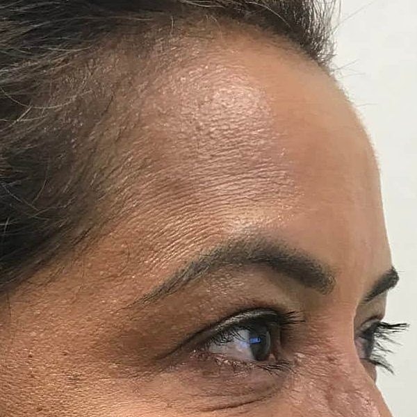 Botox Before & After