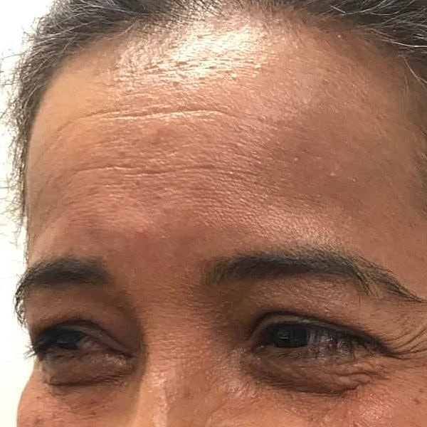 Botox Before & After