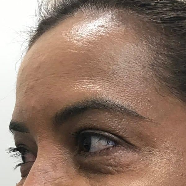 Botox Before & After