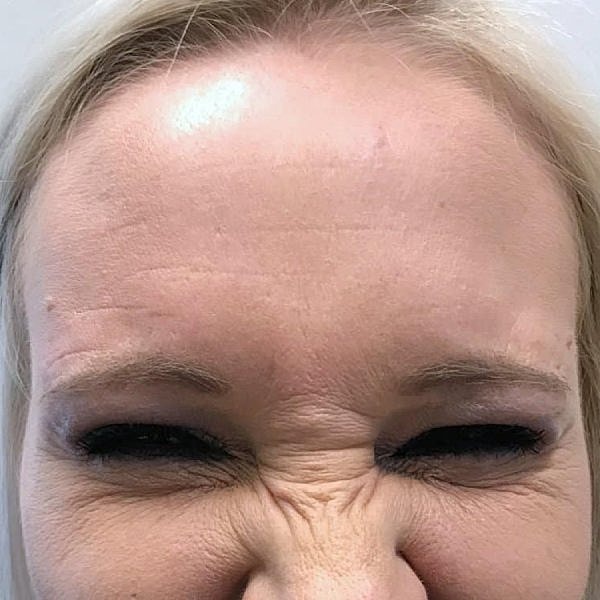 Botox Before & After