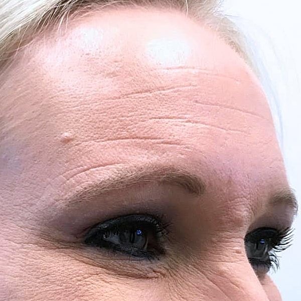 Botox Before & After