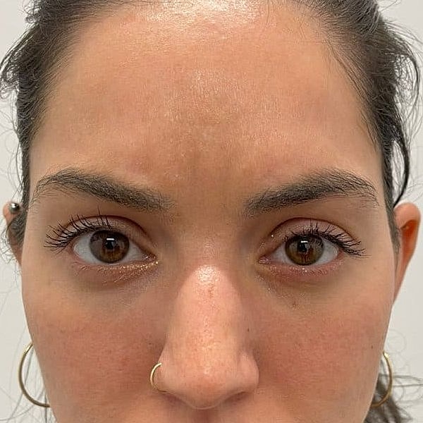 Botox Before & After