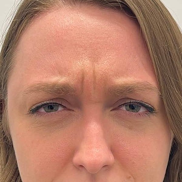 Botox Before & After