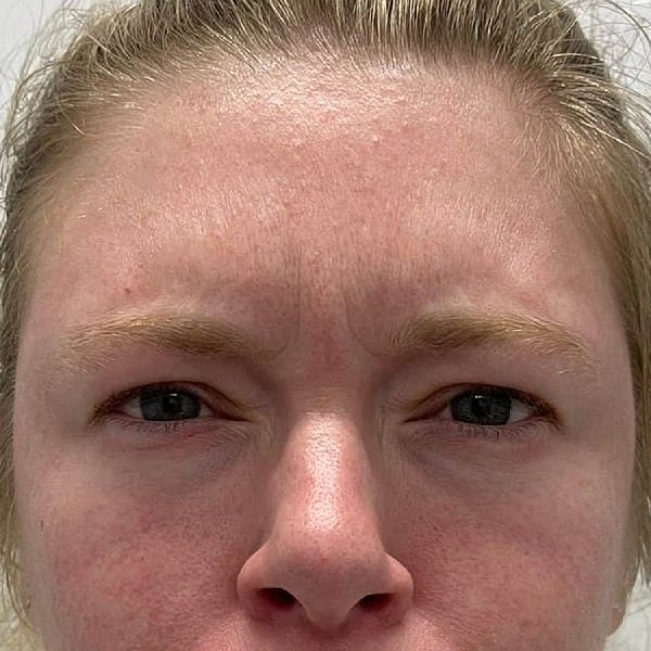 Botox Before & After