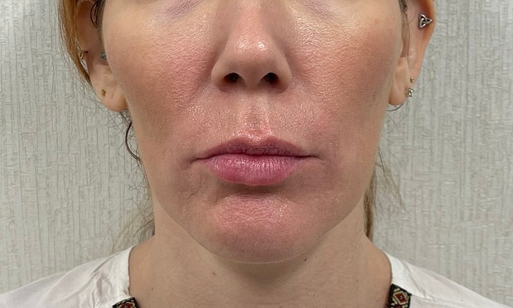 Lip Fillers Before & After