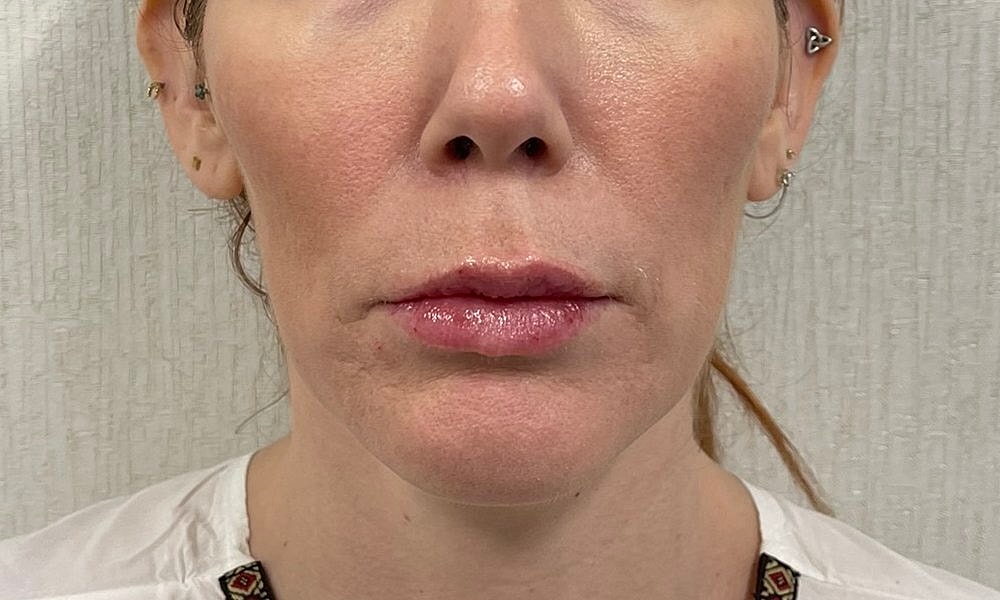 Lip Fillers Before & After