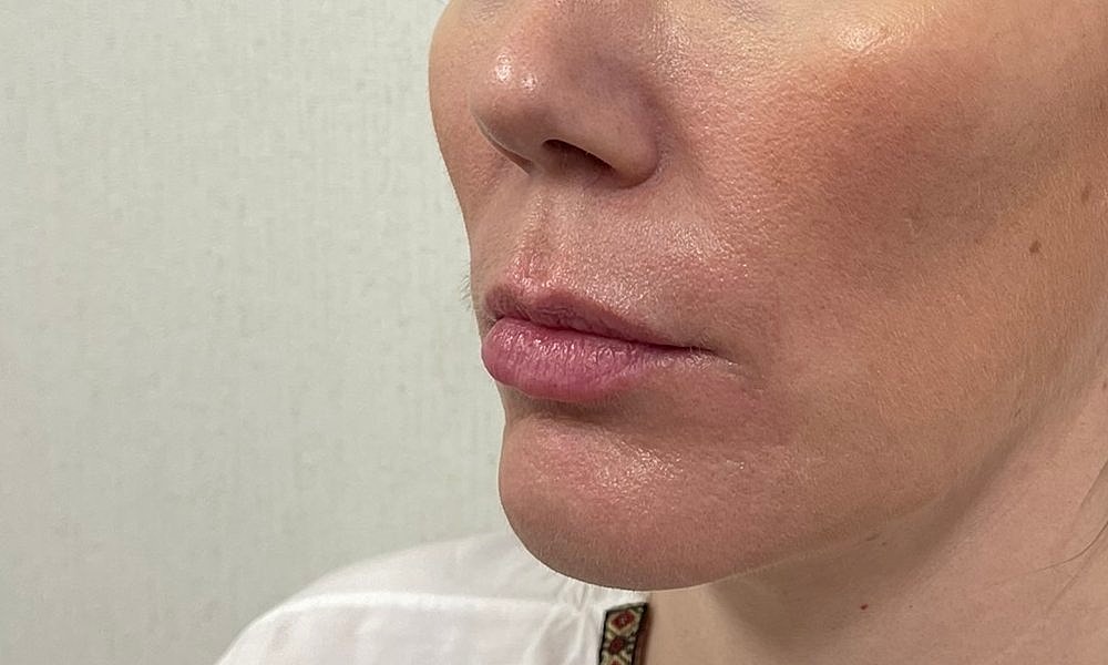 Lip Fillers Before & After