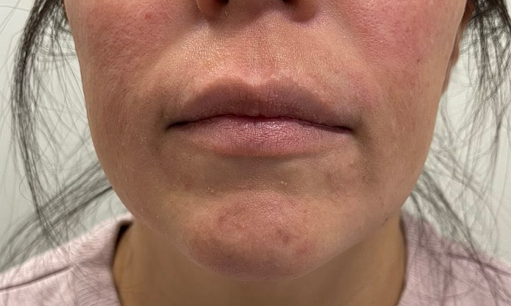 Lip Fillers Before & After